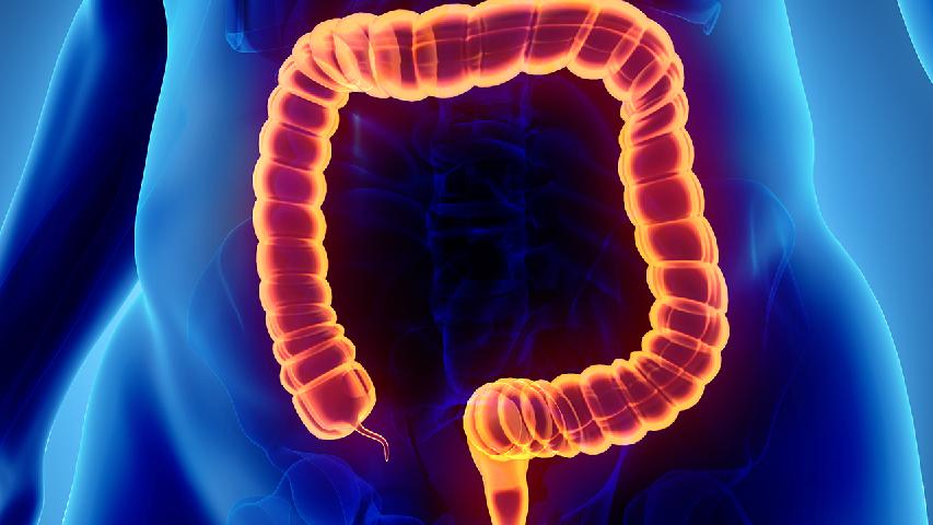 什么是结肠中分化腺癌