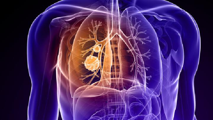 非小细胞肺癌的晚期症状
