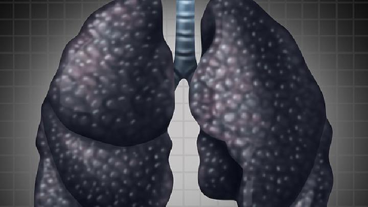 肺癌的4种临床类型