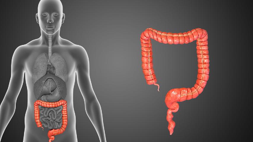 肠癌与肠道息肉的关系