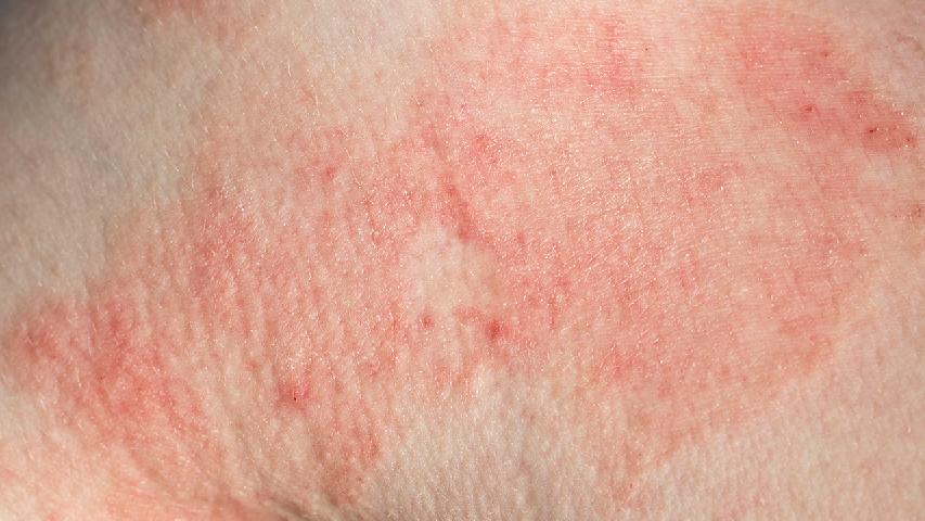 红斑 最常见的皮肤癌早期症状
