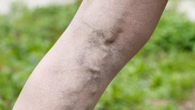 静脉曲张患者可泡足或熏洗