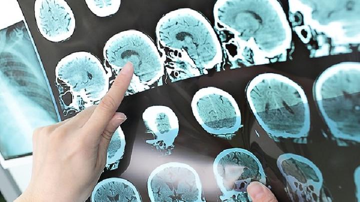 脑瘤易发生脑积水的4个常见位置
