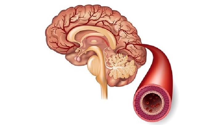 腦癌的幾種易發(fā)人群