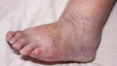 诊断精索静脉曲张的2个注意事项