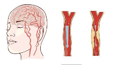 改善腦癌患者睡眠的特色中醫(yī)療法