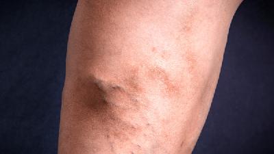 微创刨吸术治疗下肢静脉曲张的优势