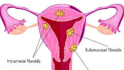 药物刮宫法可治无排卵性功能性子宫出血