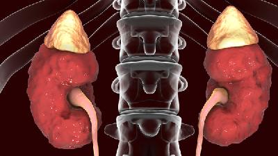 急性腎盂腎炎患者的抗感染治療