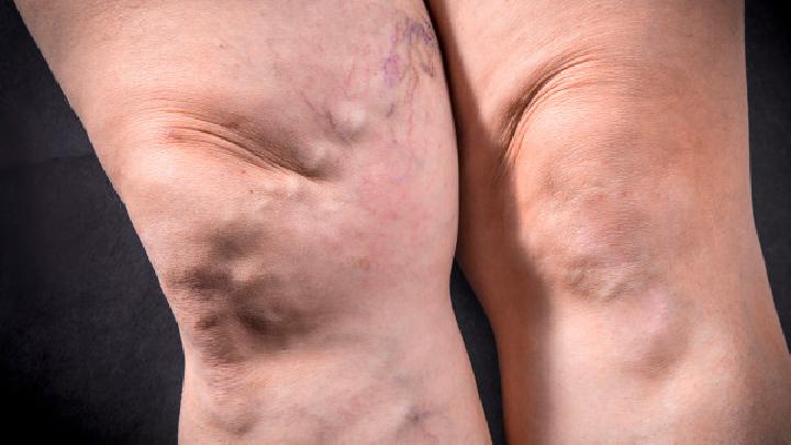 股骨頭壞死的臨床進(jìn)展情況