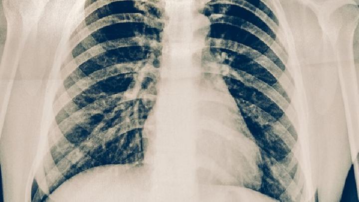 肺癌的放疗技术