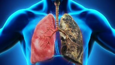 肺癌的肺部症状表现