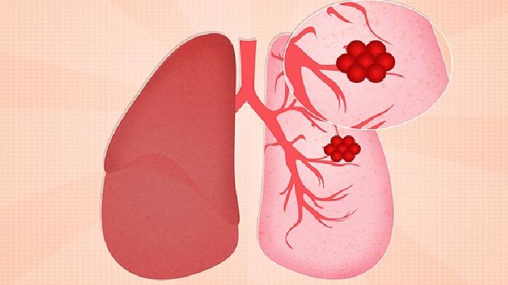 肺癌的鉴别诊断