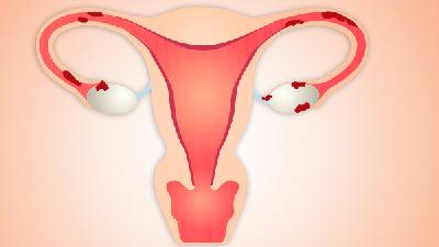 二甲双胍治疗多囊卵巢综合征引致不孕效果佳