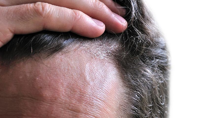 具体分析预防脱发的一系列方法