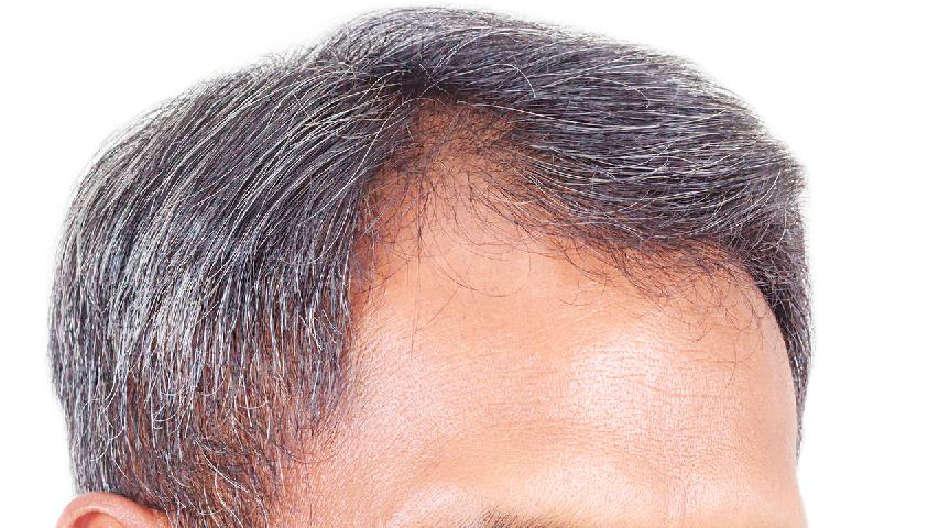 什么表现是典型会出现的脂溢性脱发的症状