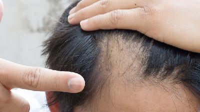 脱发是怎么引起的