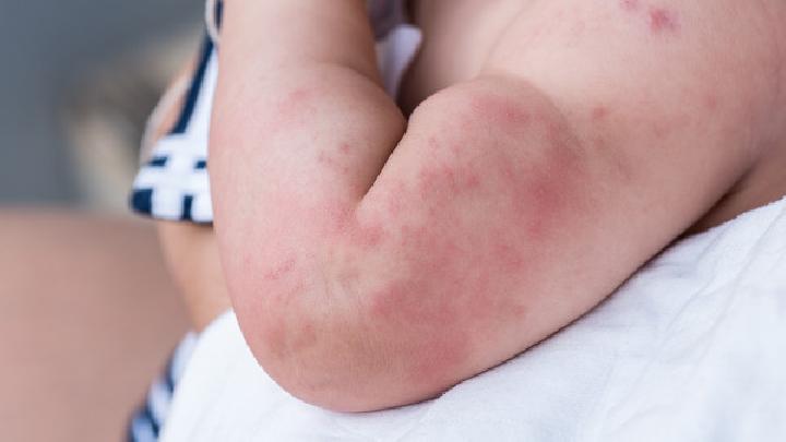 儿童荨麻疹怎么护理