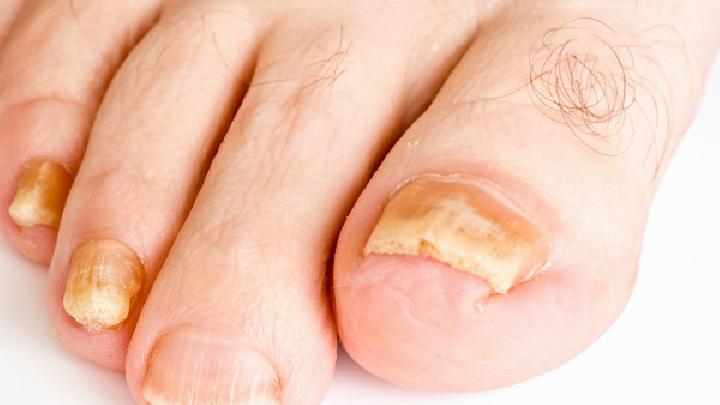 灰指甲的六大临床症状