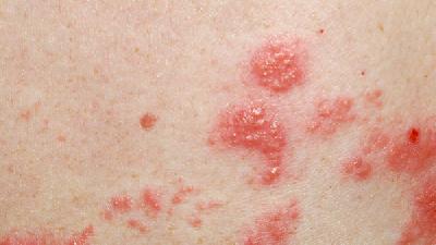 黄褐斑的3点非议