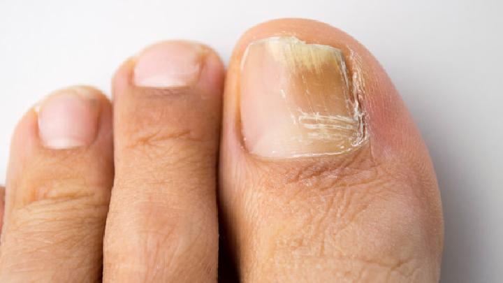 预防灰指甲洗脚要洗脚趾缝