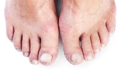 过敏性痤疮患者洗澡的注意事项