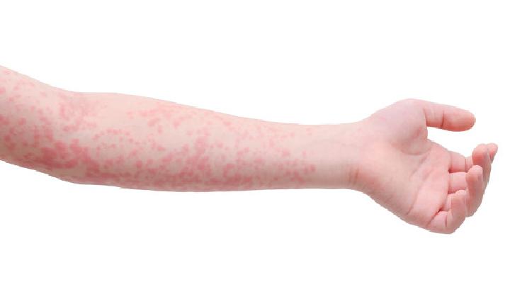 荨麻疹的皮肤及全身症状