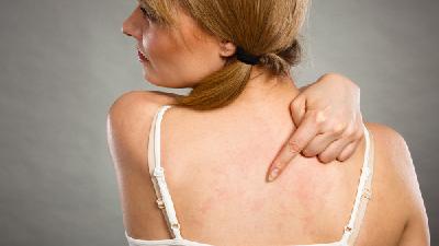 女性外阴荨麻疹患者注意事项