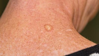 预防黄褐斑从了解病因开始