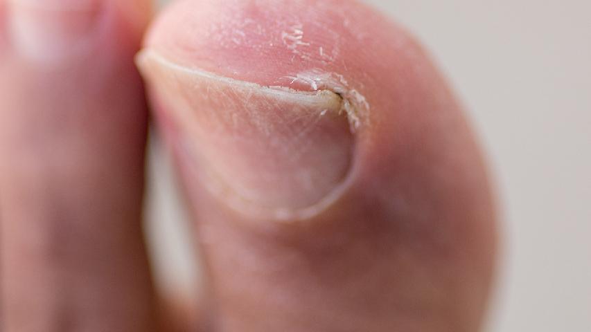 甲溝炎的7個(gè)自我治療法