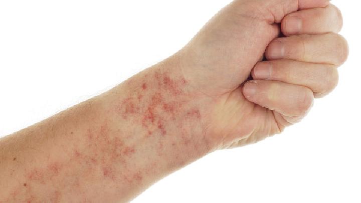 由青霉素过敏所引起的荨麻疹如何治疗