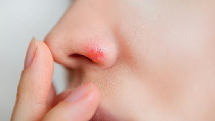 急性鼻炎如何预防？
