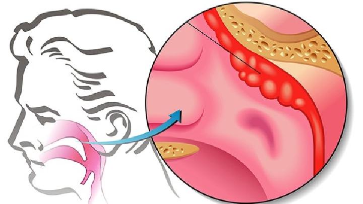鼻窦炎是什么原因引起的