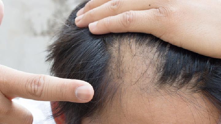 抑制脱发采用生姜治疗方法