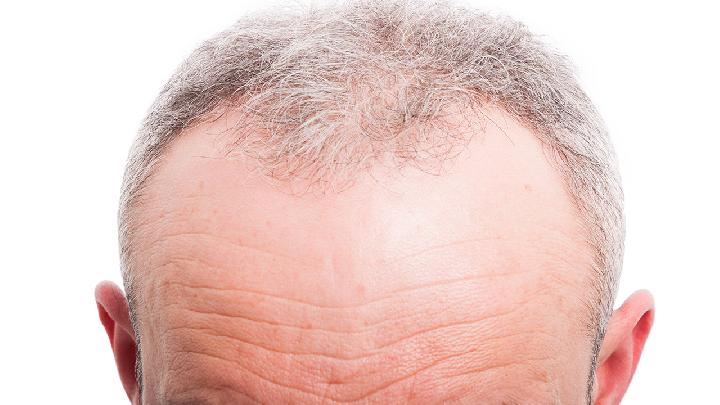 男人脱发的三个主要因素
