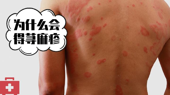 接触性荨麻疹会有什么症状