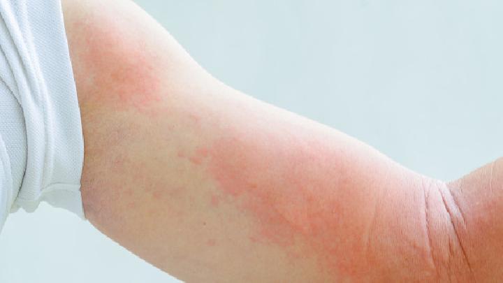 详细分析荨麻疹的症状