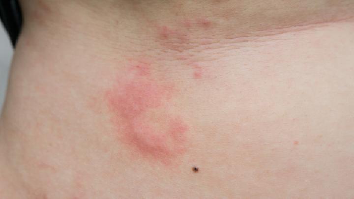 您是否认识荨麻疹这种皮肤病呢?