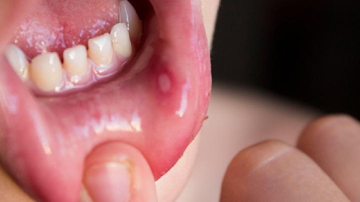 口腔溃疡有哪些的症状