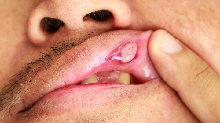 口腔溃疡治疗方法　　
