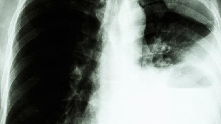 如何治疗小儿肺脓肿