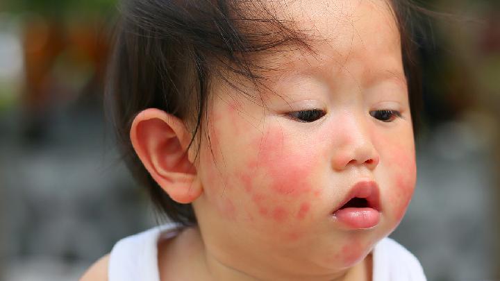 新生儿湿疹的症状表现