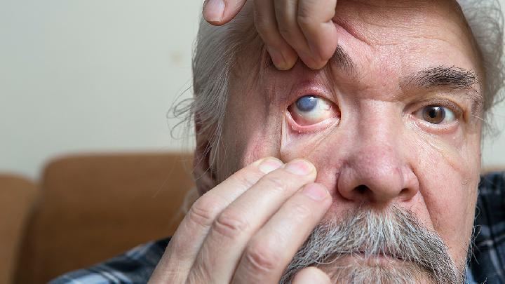 炎症相关性青光眼怎么治疗