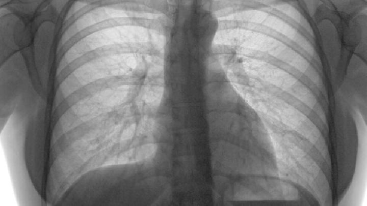 肺动脉闭锁的手术治疗效果如何？