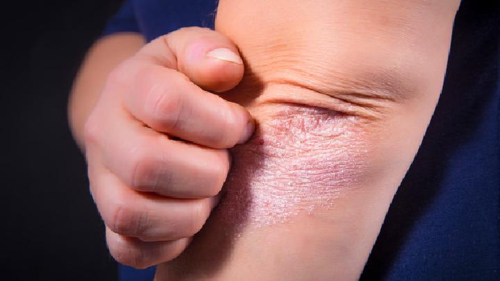 什么原因会引起乳房湿疹