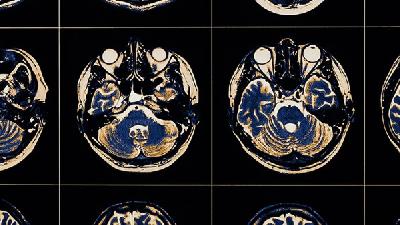 婴儿共济失调型脑瘫药物治疗