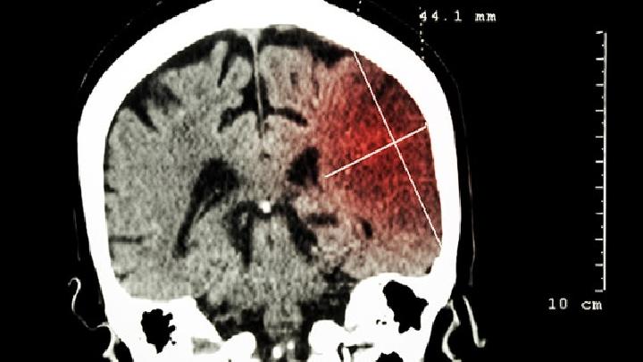孩子大腦性癱瘓最重要檢查