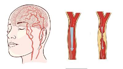 少年肌陣攣性腦癱