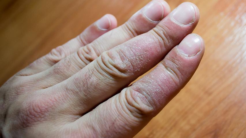 牛皮癬會傳染給其他人嗎
