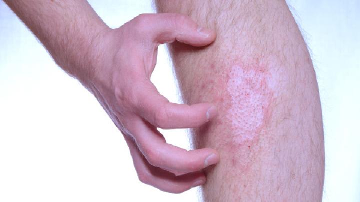對(duì)于治療牛皮癬不要走彎路